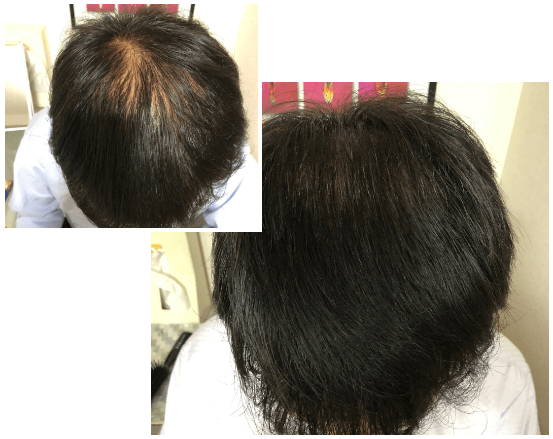 男性発毛症例