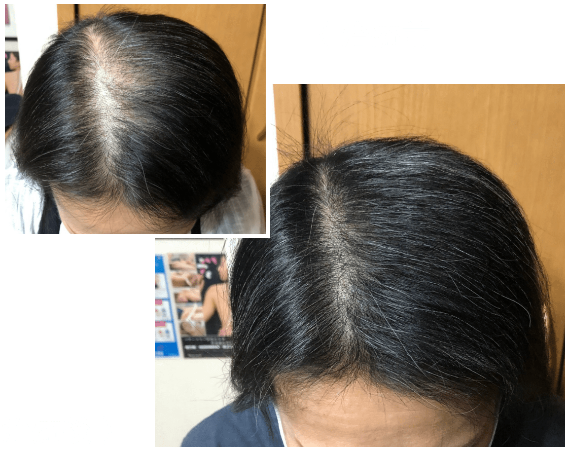 女性発毛症例